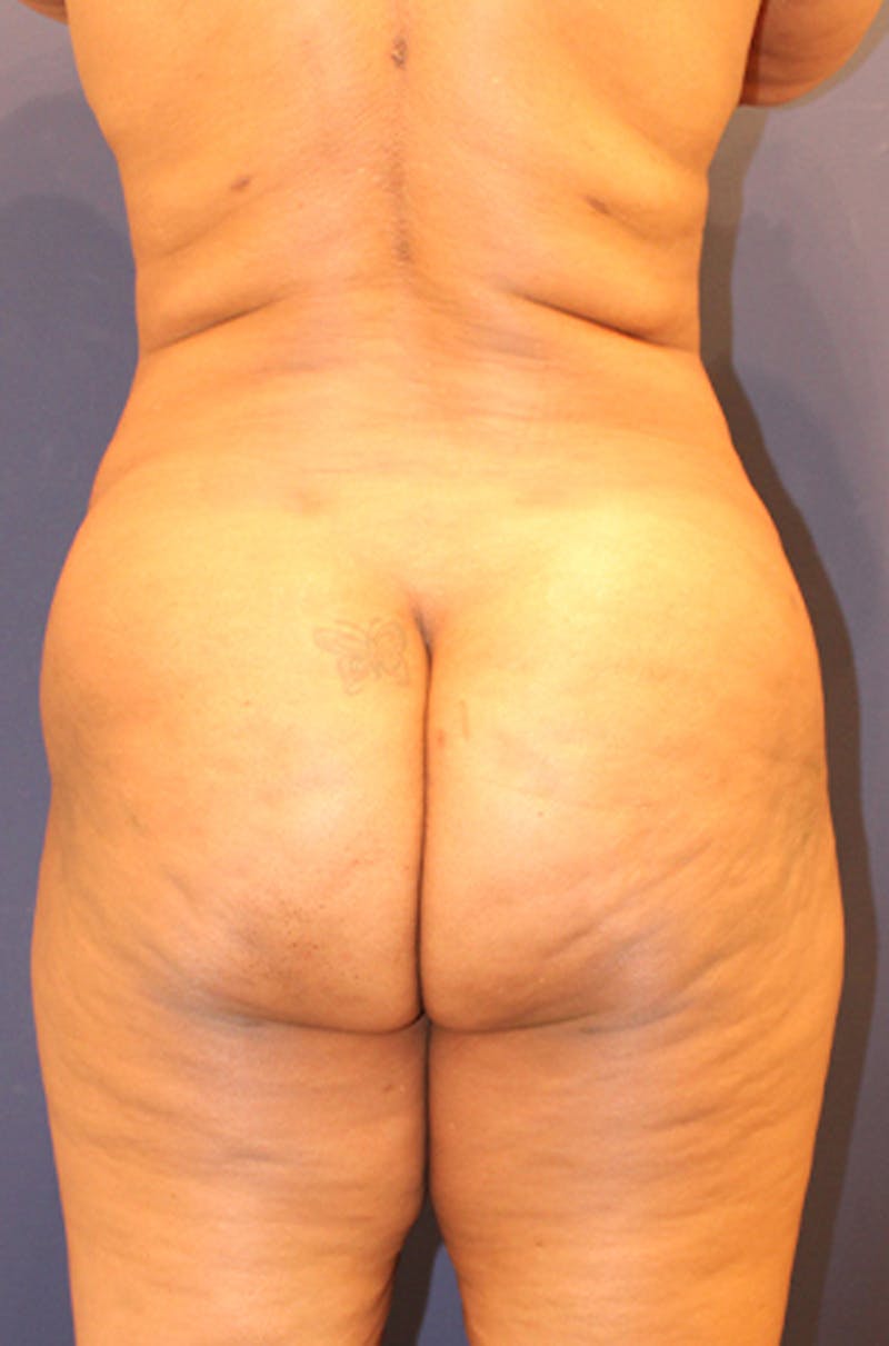 Buttock Fat Transfer Before & After Gallery - Patient 174160949 - Image 2