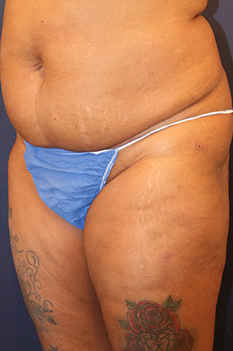 Buttock Fat Transfer Before & After Gallery - Patient 174160949 - Image 3