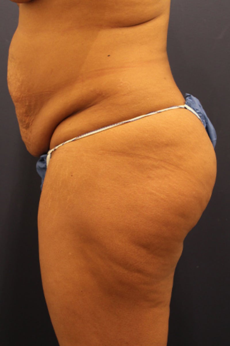 Buttock Fat Transfer Before & After Gallery - Patient 174160942 - Image 5