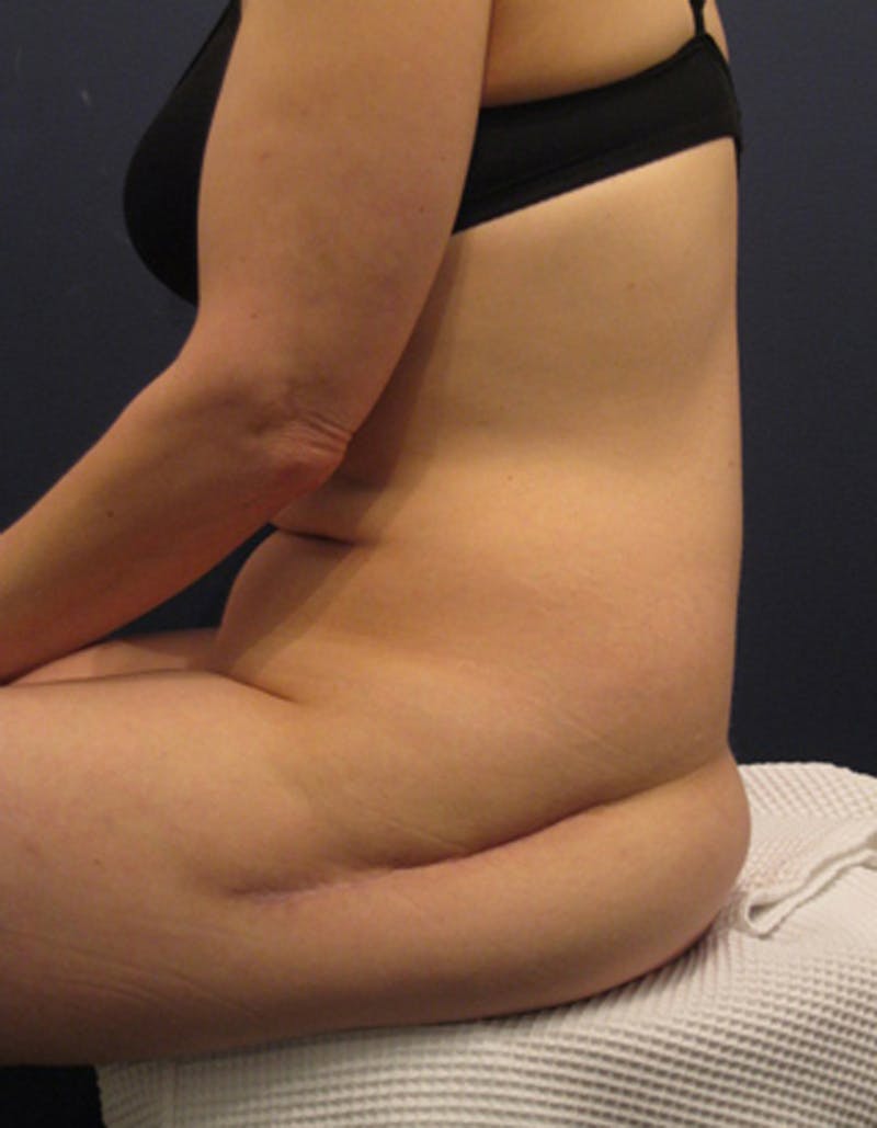 Buttock Fat Transfer Before & After Gallery - Patient 174163158 - Image 3