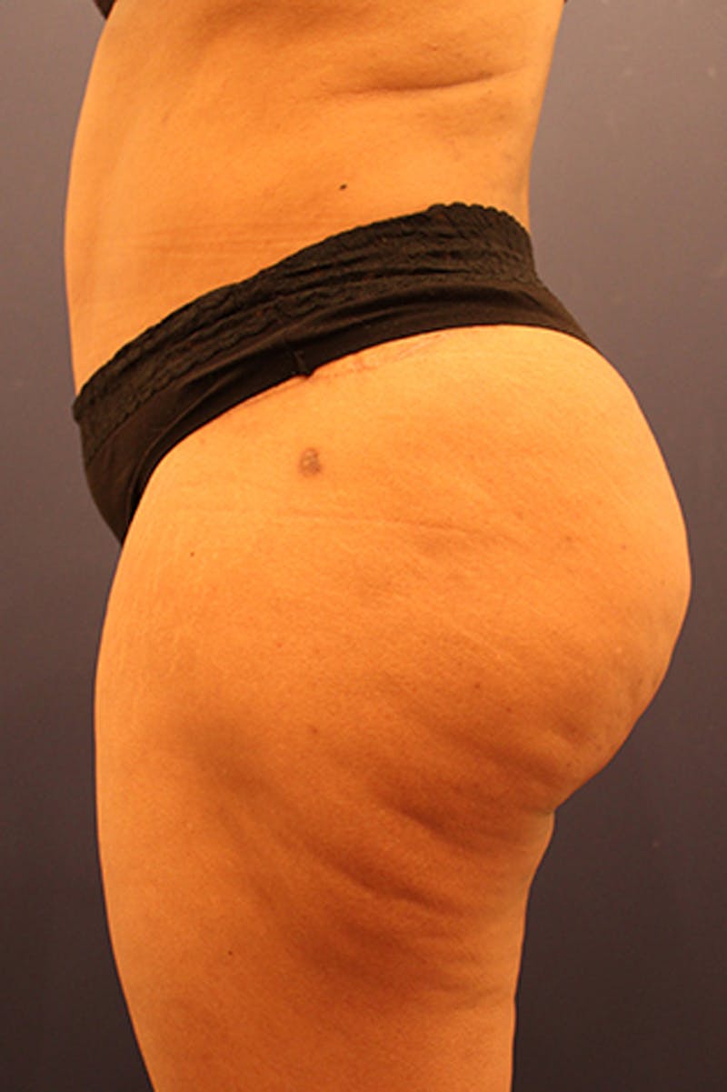 Buttock Fat Transfer Before & After Gallery - Patient 174160942 - Image 6