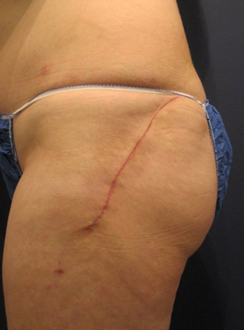 Buttock Fat Transfer Before & After Gallery - Patient 174163158 - Image 2