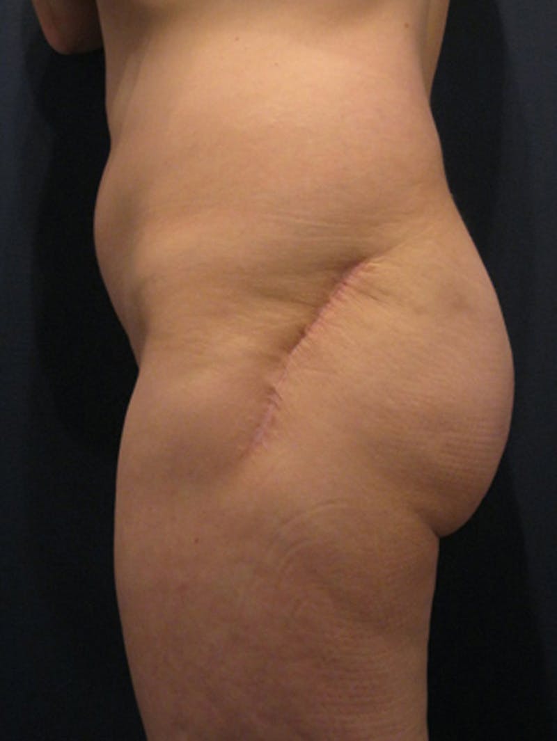 Buttock Fat Transfer Before & After Gallery - Patient 174163158 - Image 5