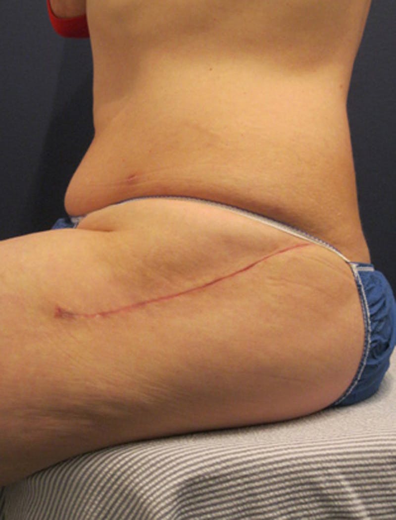Buttock Fat Transfer Before & After Gallery - Patient 174163158 - Image 4