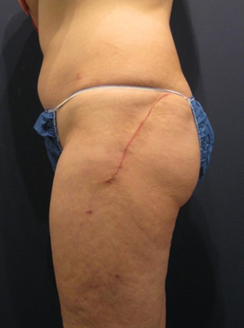 Buttock Fat Transfer Before & After Gallery - Patient 174163158 - Image 6