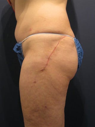 Buttock Fat Transfer Before & After Gallery - Patient 174163158 - Image 6