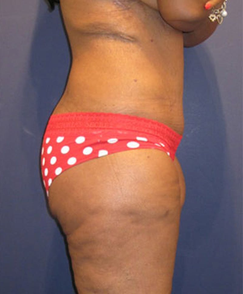 Buttock Fat Transfer Before & After Gallery - Patient 174162076 - Image 4
