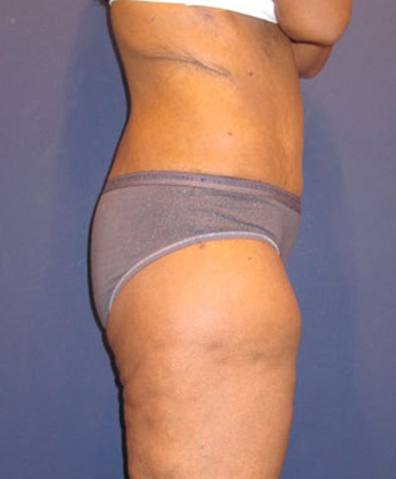Buttock Fat Transfer Before & After Gallery - Patient 174162076 - Image 3
