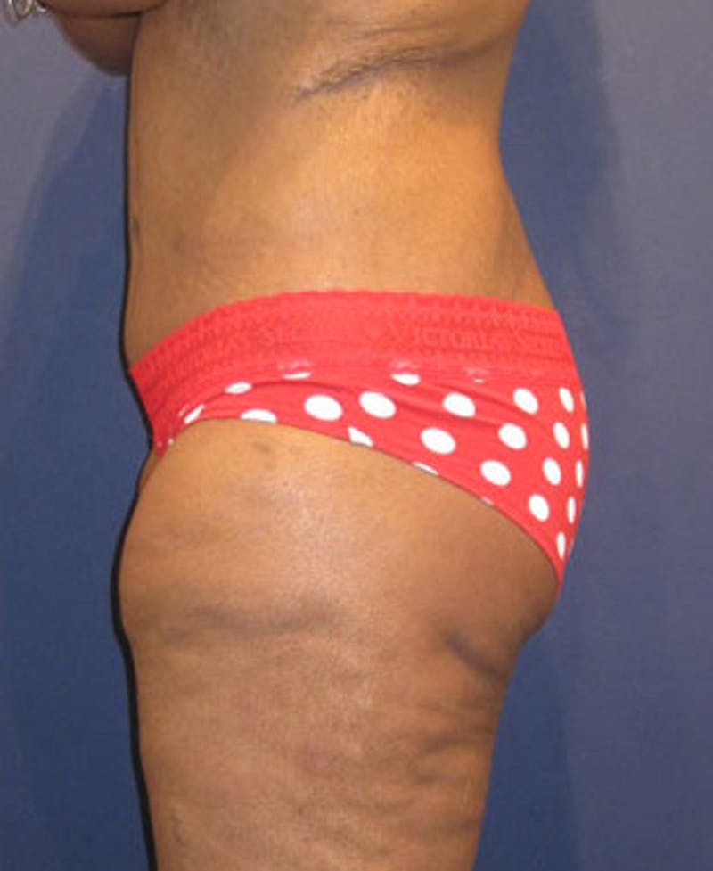 Buttock Fat Transfer Before & After Gallery - Patient 174162076 - Image 2