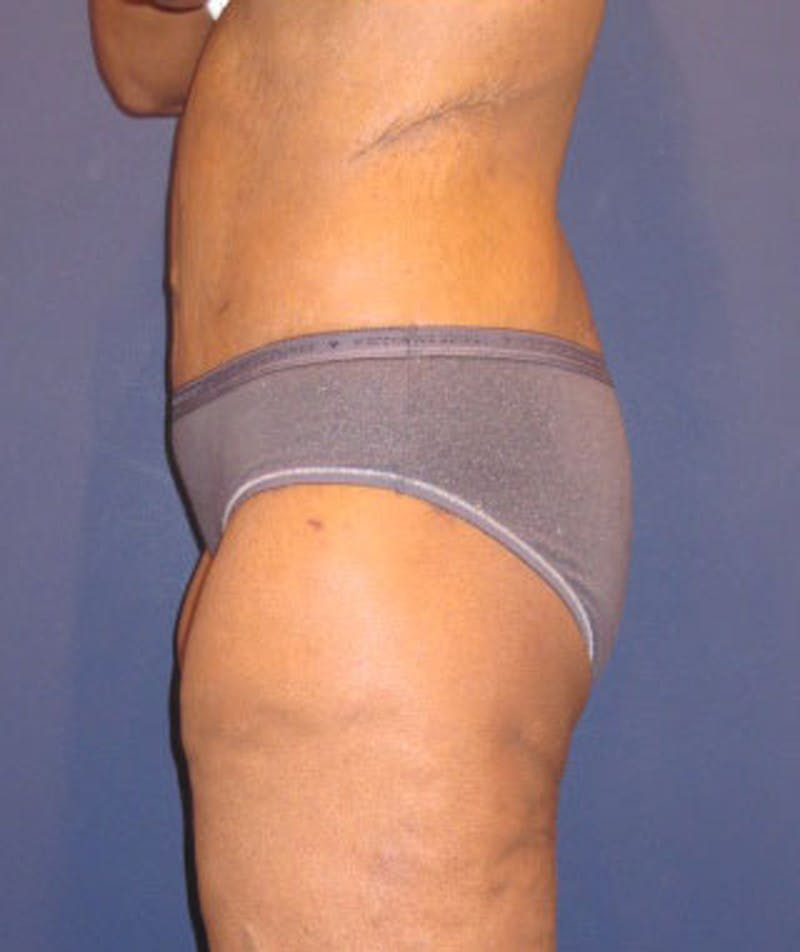 Buttock Fat Transfer Before & After Gallery - Patient 174162076 - Image 1