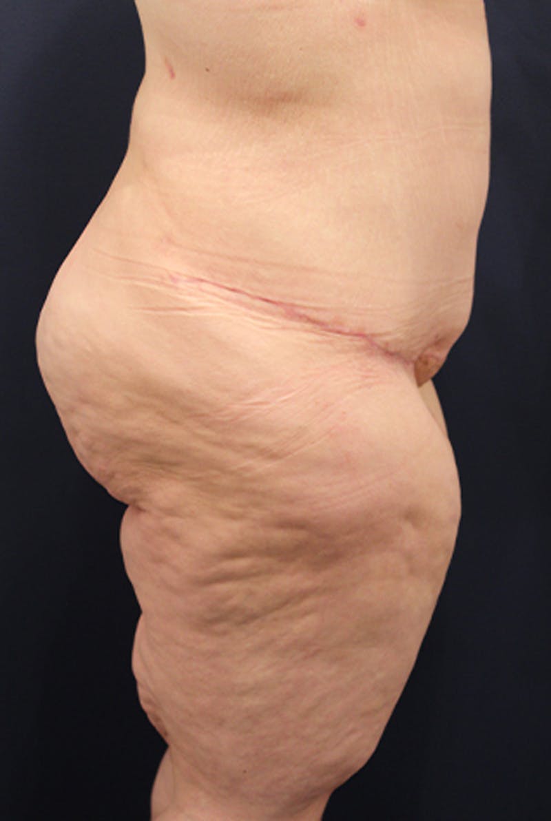 Buttock Fat Transfer Before & After Gallery - Patient 174162055 - Image 6