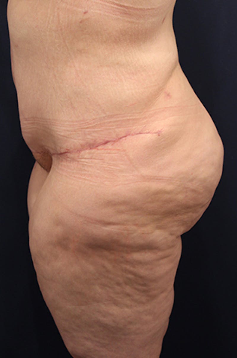 Buttock Fat Transfer Before & After Gallery - Patient 174162055 - Image 4