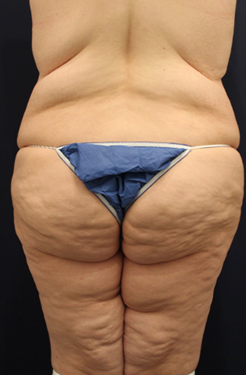 Buttock Fat Transfer Before & After Gallery - Patient 174162055 - Image 1