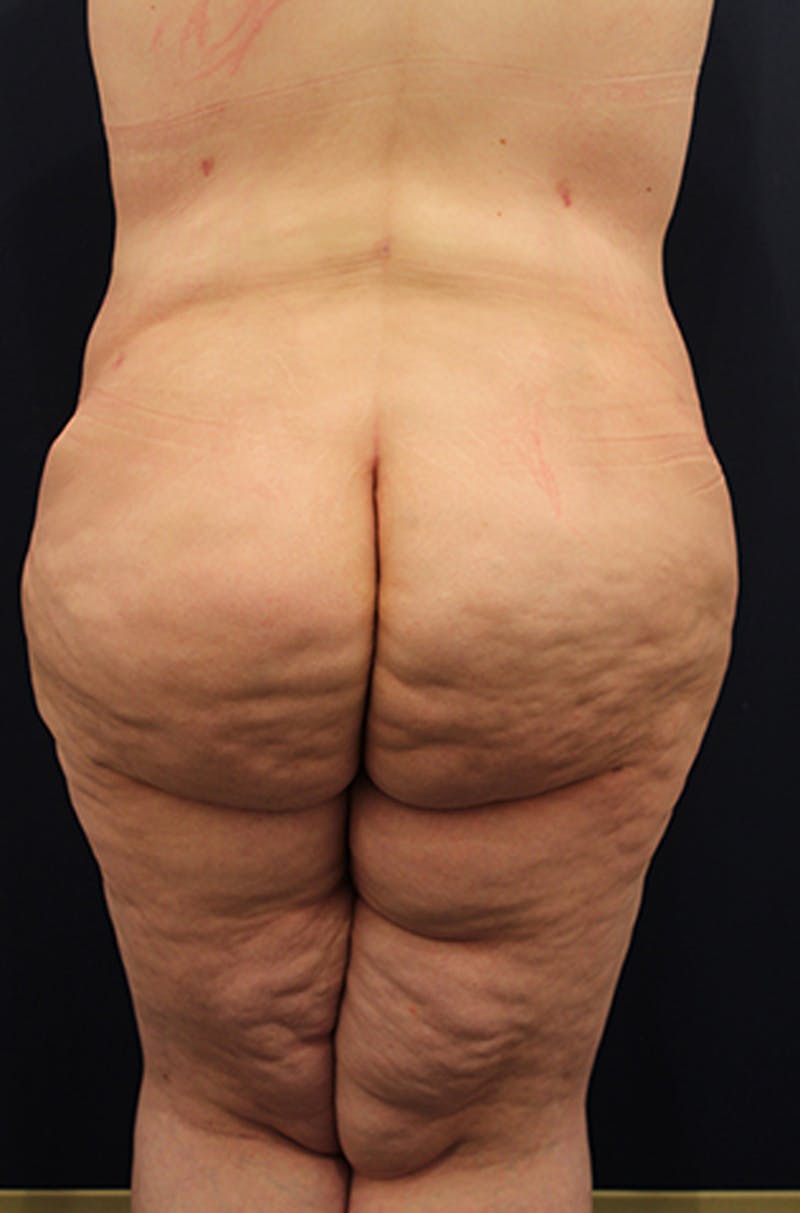 Buttock Fat Transfer Before & After Gallery - Patient 174162055 - Image 2