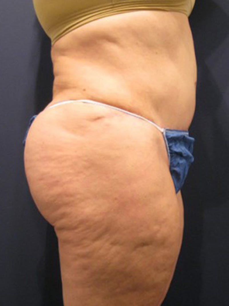 Buttock Fat Transfer Before & After Gallery - Patient 174162067 - Image 4