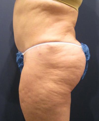 Buttock Fat Transfer Before & After Gallery - Patient 174162067 - Image 2