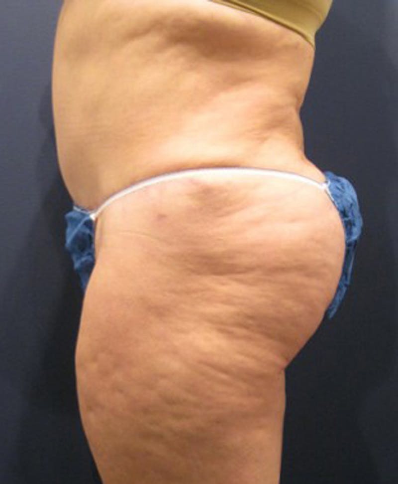 Buttock Fat Transfer Before & After Gallery - Patient 174162067 - Image 2