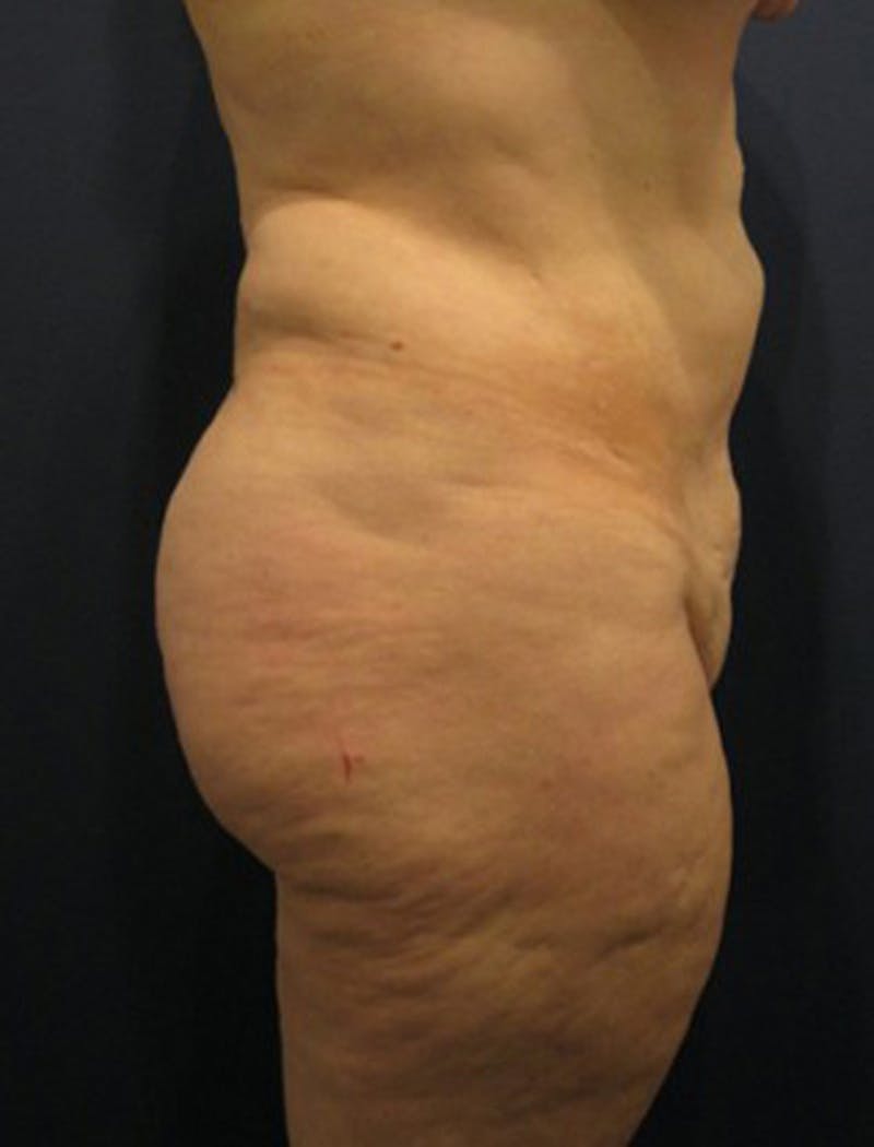 Buttock Fat Transfer Before & After Gallery - Patient 174162067 - Image 3