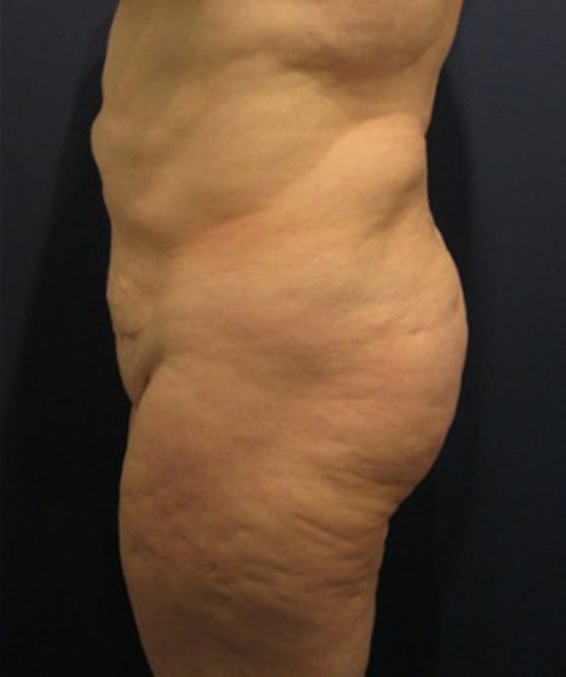 Buttock Fat Transfer Before & After Gallery - Patient 174162067 - Image 1