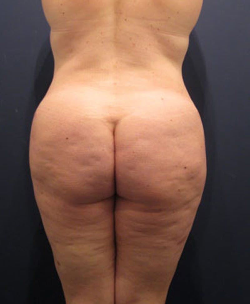 Buttock Fat Transfer Before & After Gallery - Patient 174162062 - Image 6