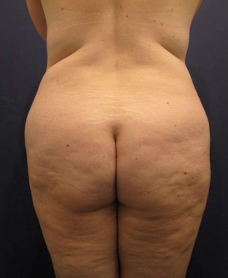 Buttock Fat Transfer Before & After Gallery - Patient 174162062 - Image 5