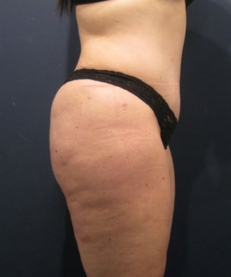Buttock Fat Transfer Before & After Gallery - Patient 174162062 - Image 4
