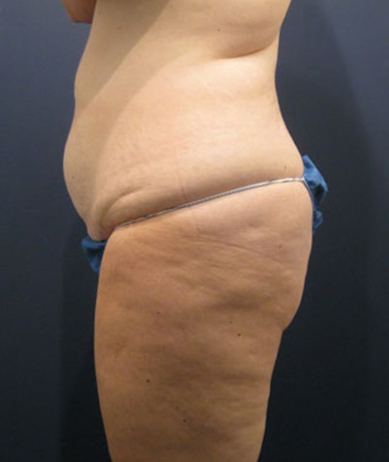 Buttock Fat Transfer Before & After Gallery - Patient 174162062 - Image 1