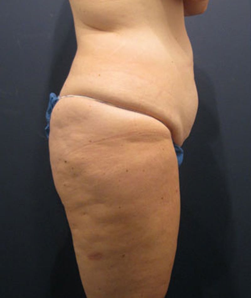 Buttock Fat Transfer Before & After Gallery - Patient 174162062 - Image 3
