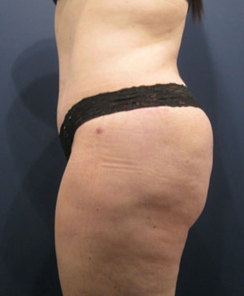 Buttock Fat Transfer Before & After Gallery - Patient 174162062 - Image 2