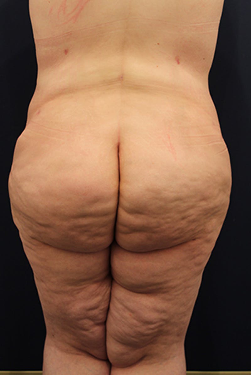 Buttock Fat Transfer Before & After Gallery - Patient 174162046 - Image 2