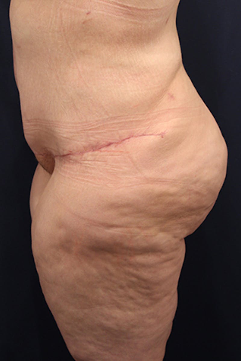 Buttock Fat Transfer Before & After Gallery - Patient 174162046 - Image 4