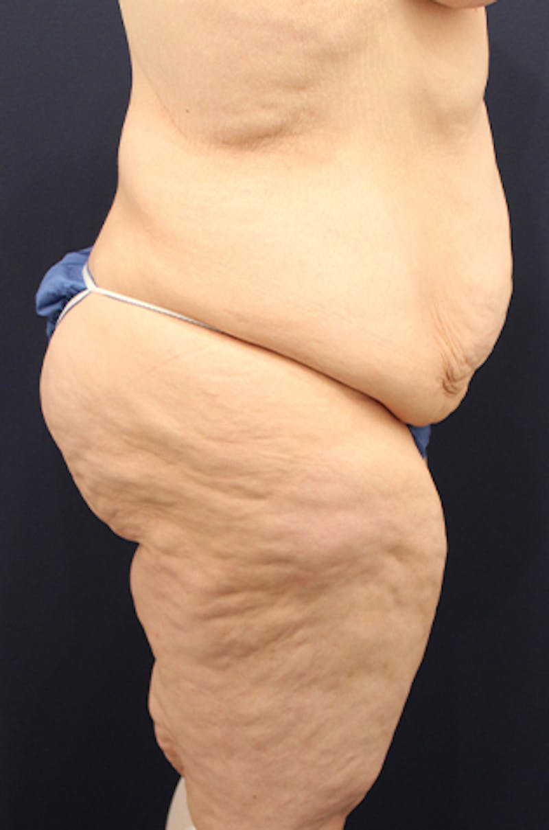 Buttock Fat Transfer Before & After Gallery - Patient 174162046 - Image 5