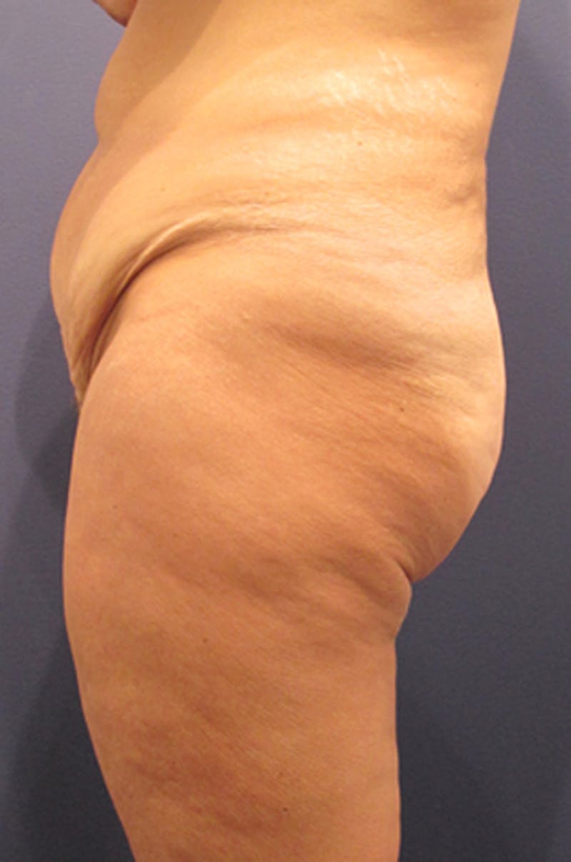 Buttock Fat Transfer Before & After Gallery - Patient 174163165 - Image 1