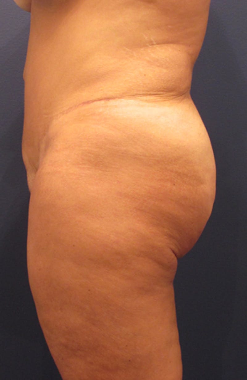 Buttock Fat Transfer Before & After Gallery - Patient 174163165 - Image 2