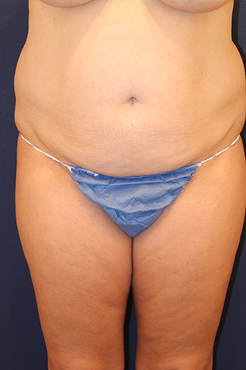 Liposuction Before & After Gallery - Patient 174160953 - Image 1