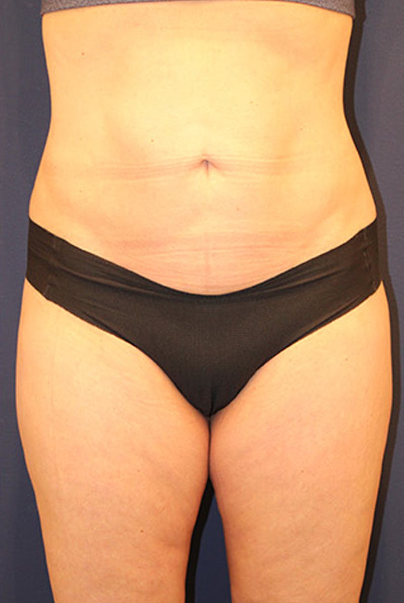 Liposuction Before & After Gallery - Patient 174160953 - Image 2