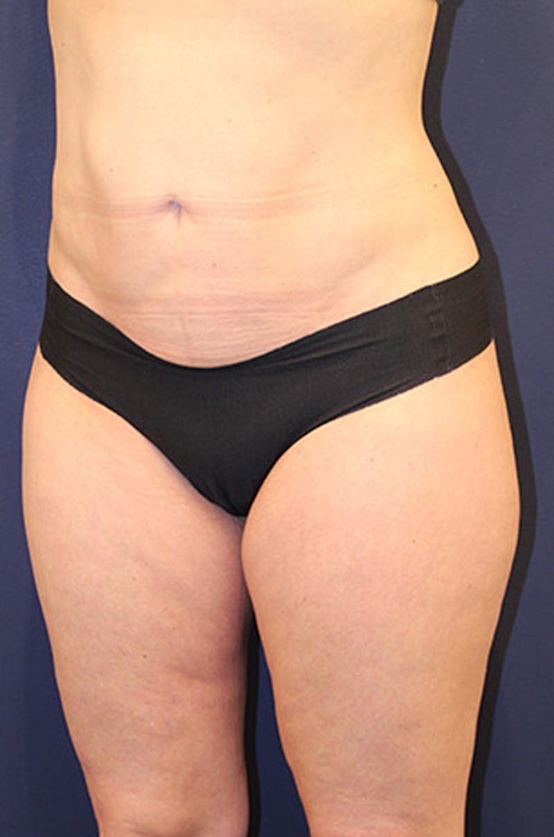 Liposuction Before & After Gallery - Patient 174160953 - Image 4