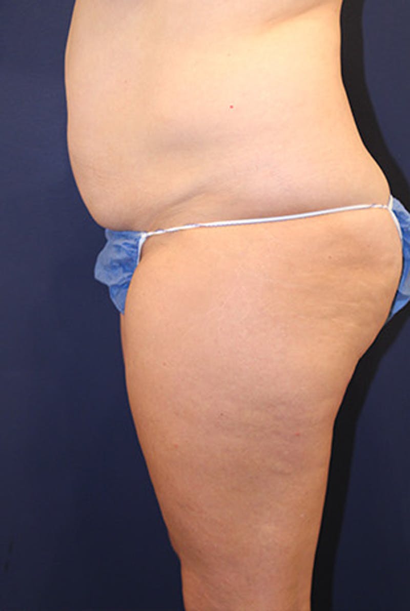 Liposuction Before & After Gallery - Patient 174160953 - Image 5