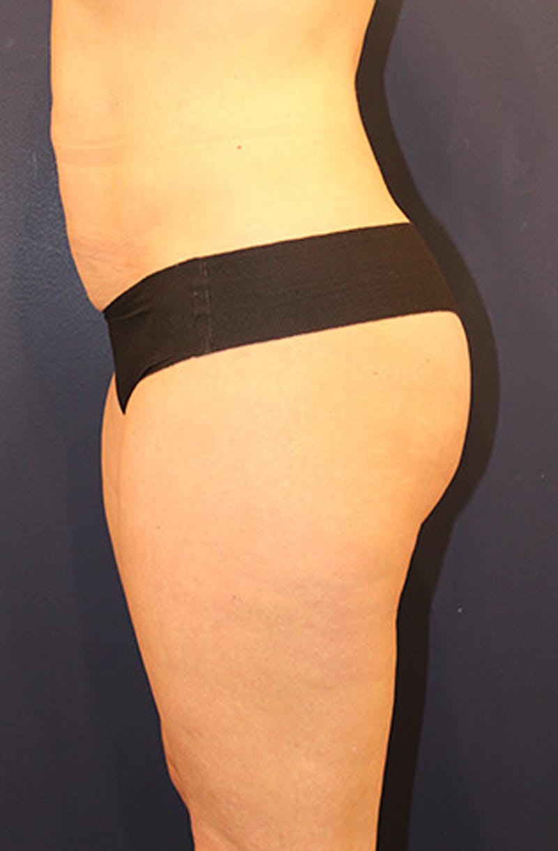 Liposuction Before & After Gallery - Patient 174160953 - Image 6