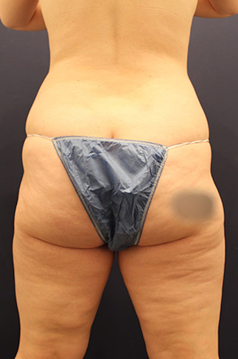 Liposuction Before & After Gallery - Patient 174160961 - Image 6