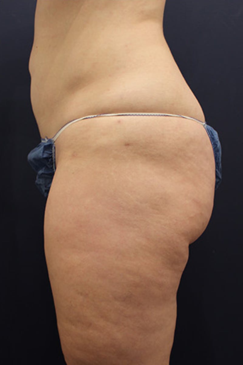 Liposuction Before & After Gallery - Patient 174160961 - Image 4