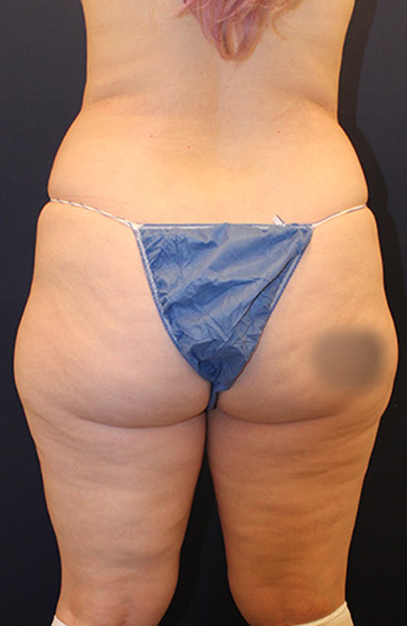 Liposuction Before & After Gallery - Patient 174160961 - Image 5