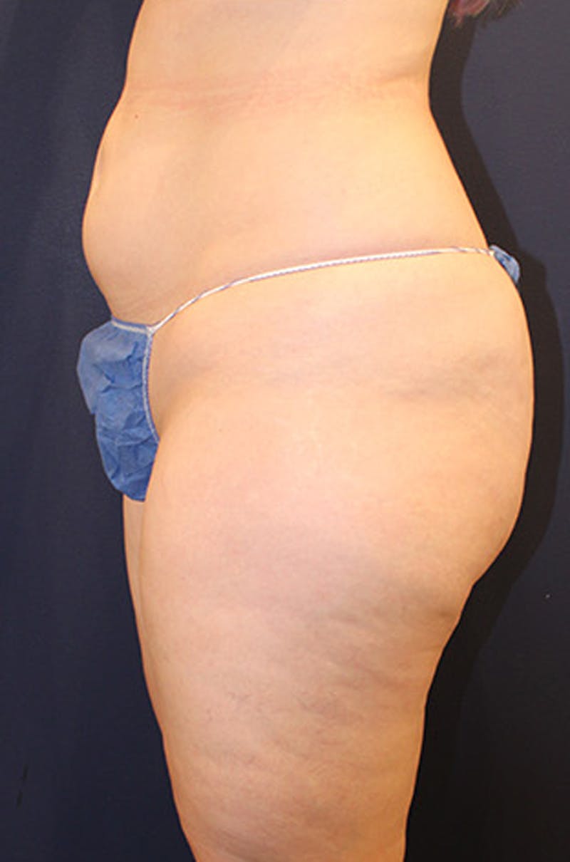 Liposuction Before & After Gallery - Patient 174160961 - Image 3