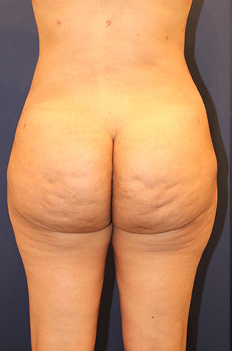 Liposuction Before & After Gallery - Patient 174160964 - Image 6