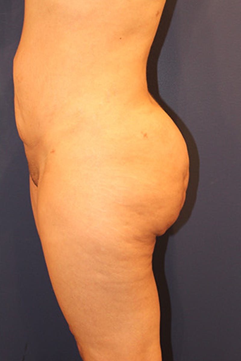 Liposuction Before & After Gallery - Patient 174160964 - Image 4