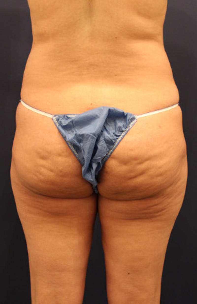 Liposuction Before & After Gallery - Patient 174160964 - Image 5