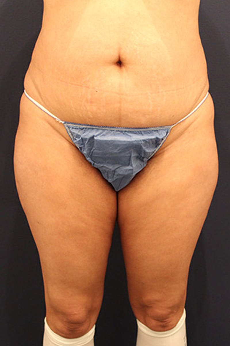 Liposuction Before & After Gallery - Patient 174160964 - Image 1