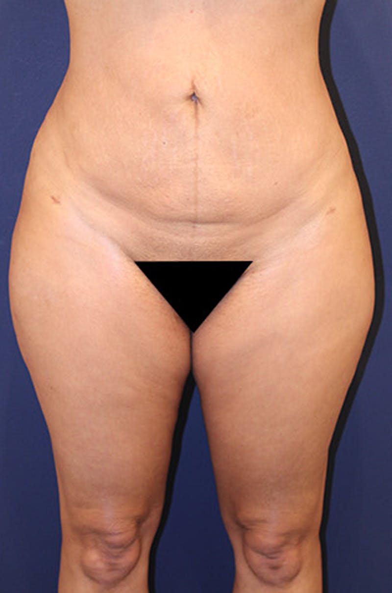 Liposuction Before & After Gallery - Patient 174160964 - Image 2