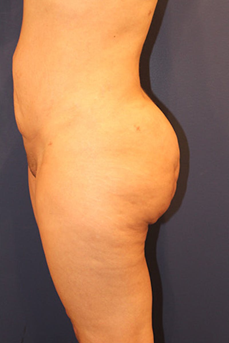 Liposuction Before & After Gallery - Patient 174160964 - Image 3