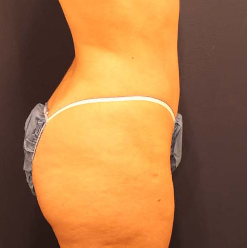 Liposuction Before & After Gallery - Patient 174162048 - Image 6